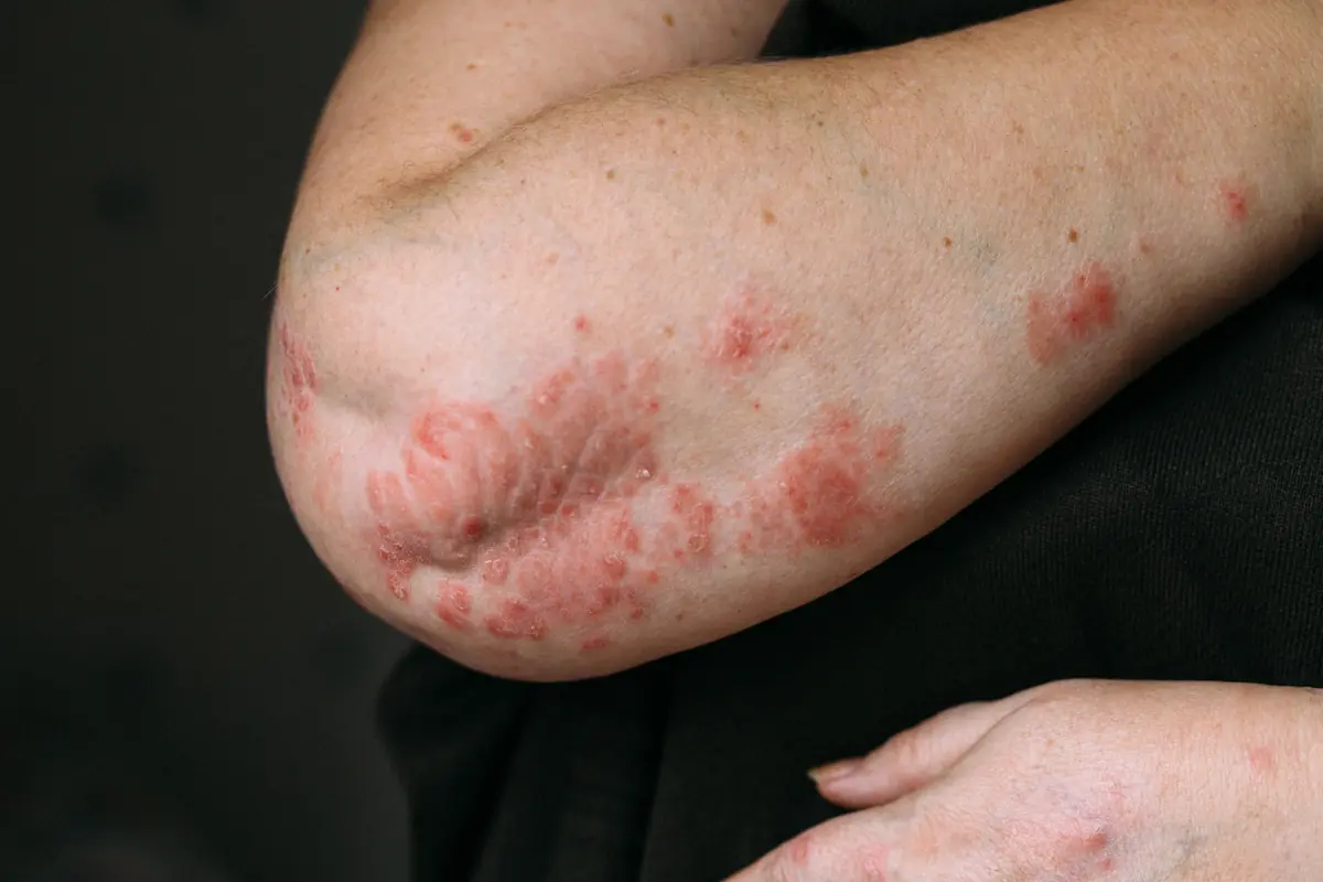 Plaques rouges d’eczéma sur un coude