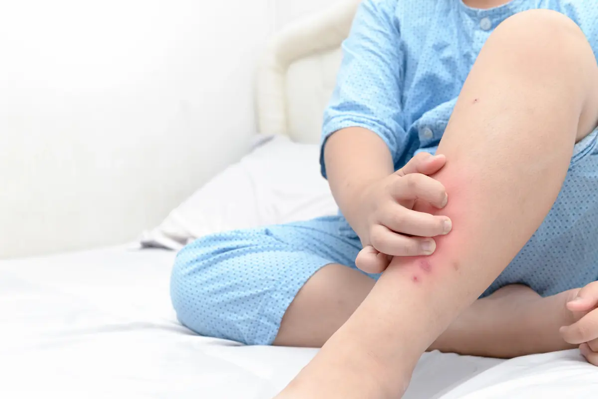 Enfant en pyjama assis sur un lit, qui se gratte la jambe