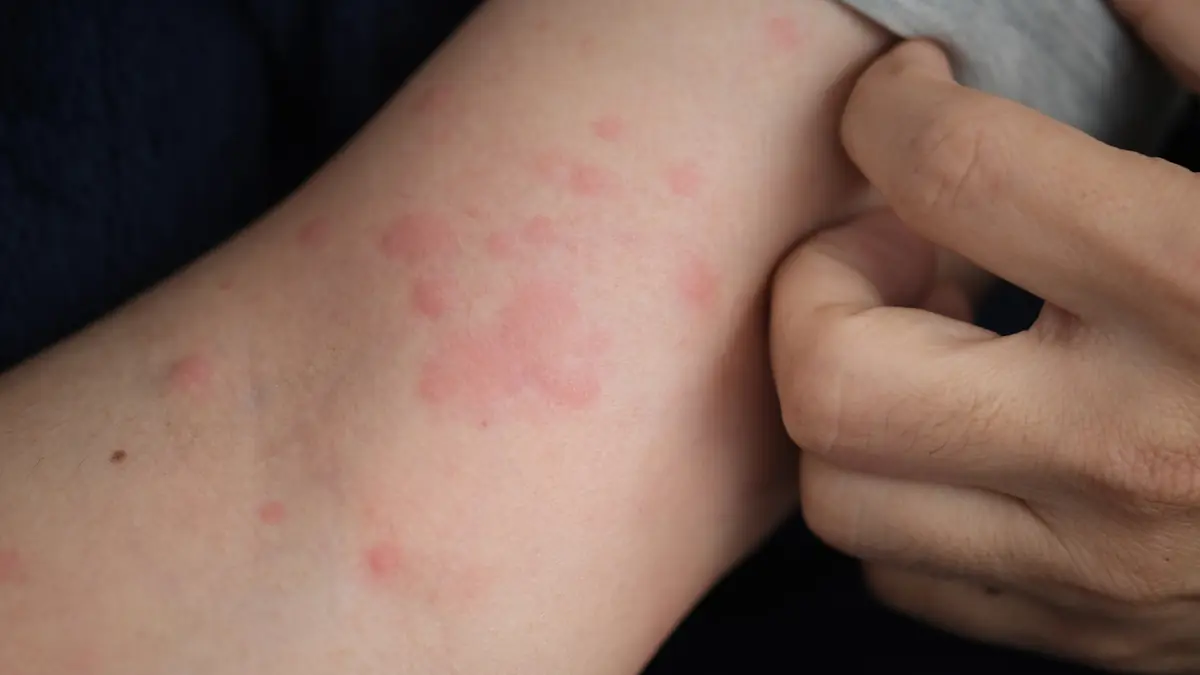 Boutons rouges sur l’intérieur du bras