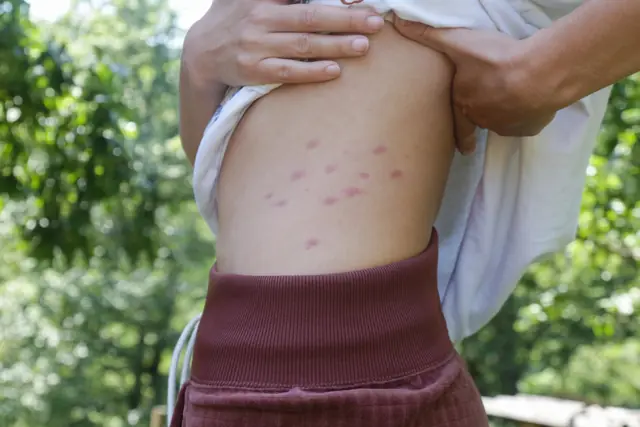 Piqûres rouges en ligne sur le flanc et le dos