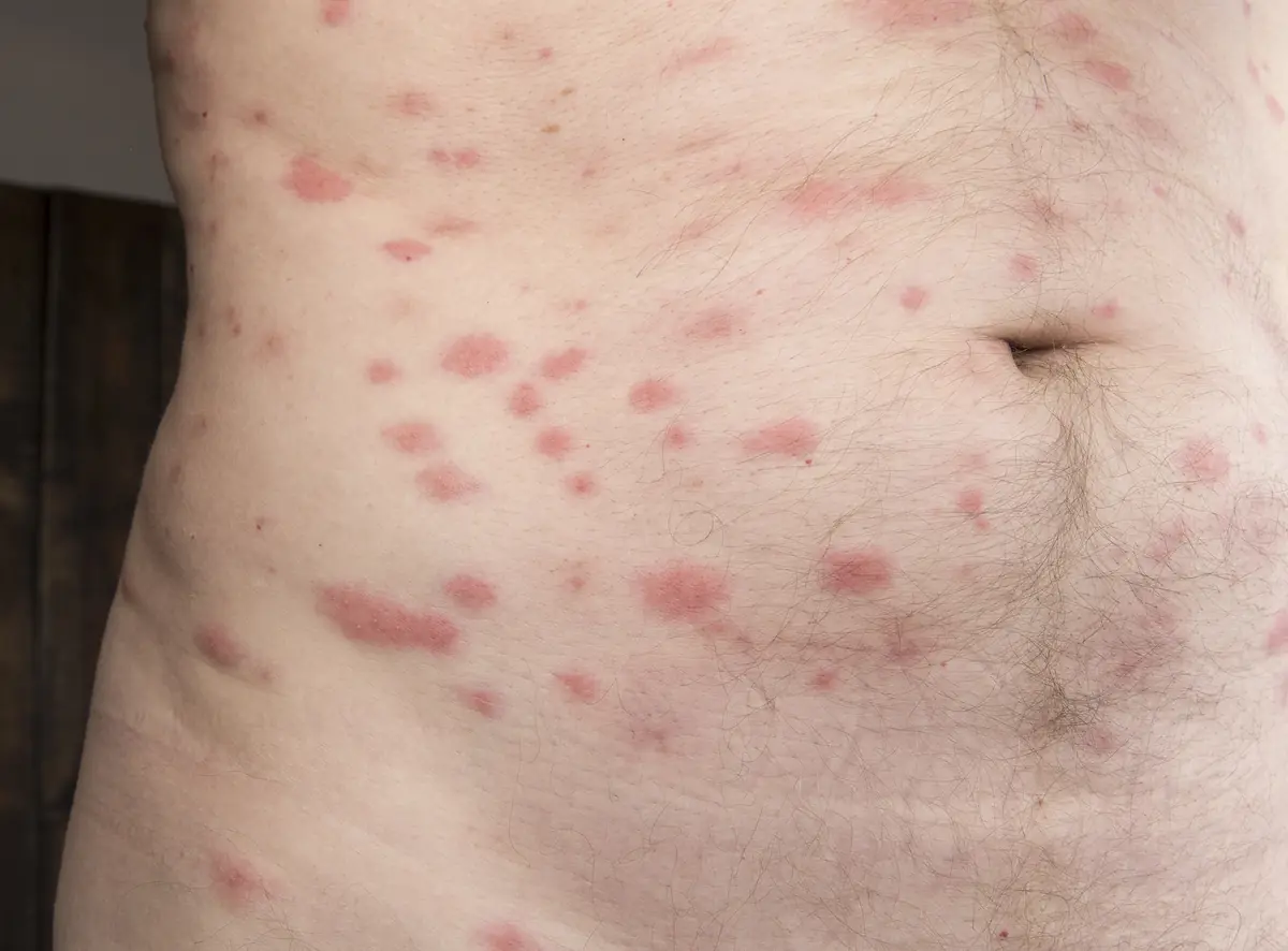 Nombreuses plaques rouges sur le ventre et le flanc