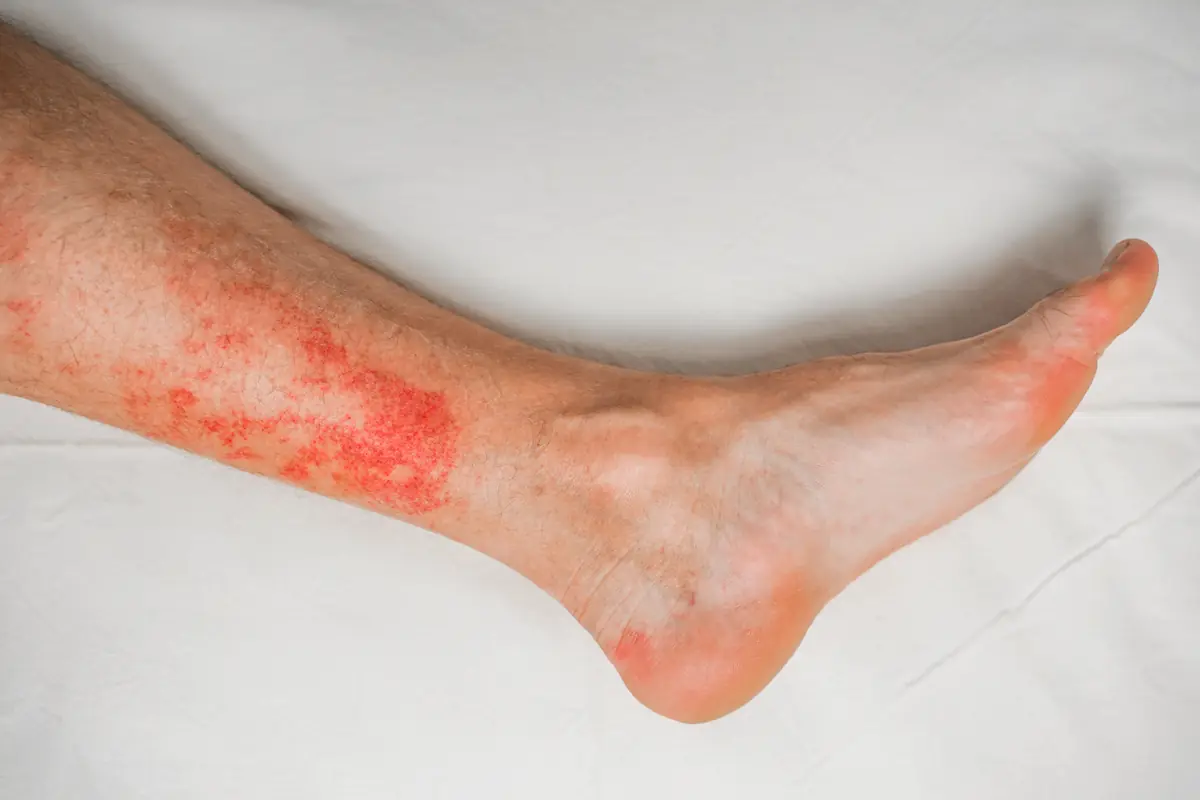 Jambe présentant une large rougeur sur le tibia