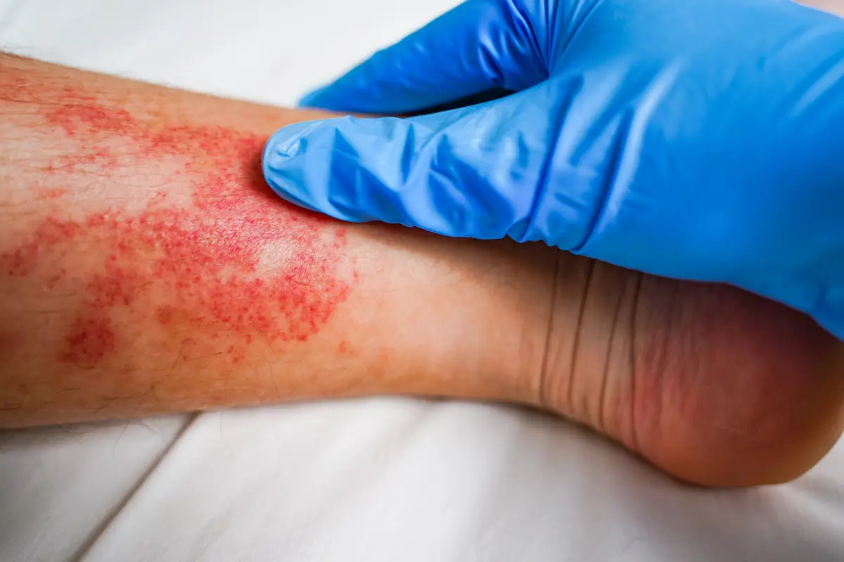 Main gantée examinant une rougeur sur la jambe